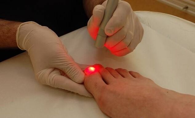 Laserbehandlung bei Zehennagelpilz