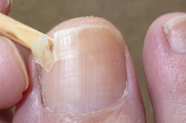 Beschädigte Nägel sind ein Risikofaktor für eine Pilzinfektion