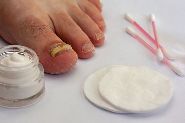 Behandlung von Fingers Pilz mit Creme aus dem Pilz