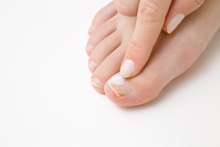 Fingerbehandlung mit Salbe aus dem Pilz