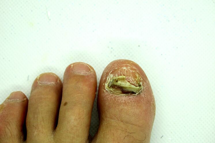 Fingernagelpilz - Schwere Bühne