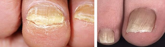 Schädigung der Nägel durch eine Pilzinfektion