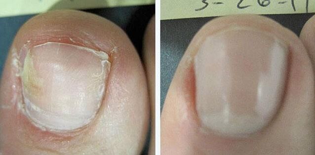 vor und nach der Behandlung von Nagelpilz